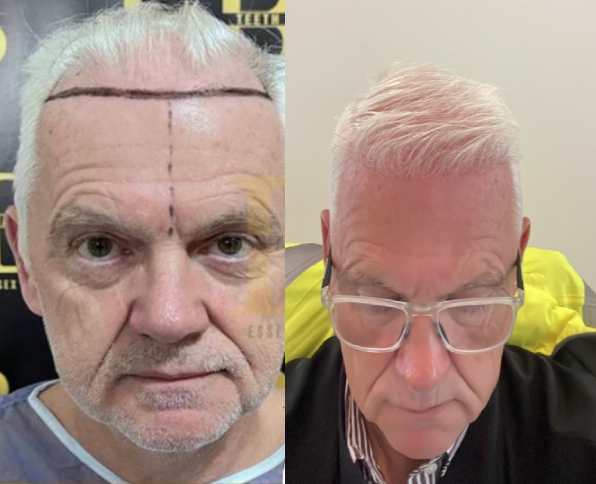 Hair Transplant