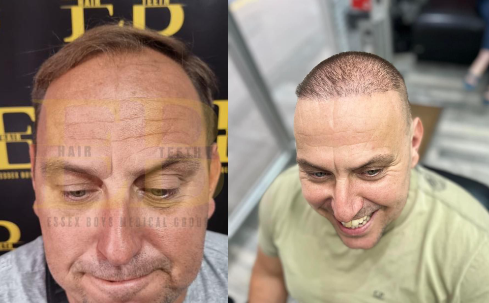 Hair transplant