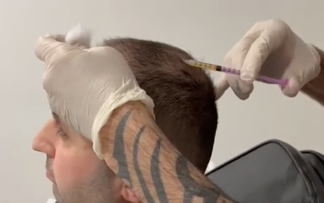 Wayne Rooney’s Hair Transformation: A Closer Look at His Hair Transplant Journey