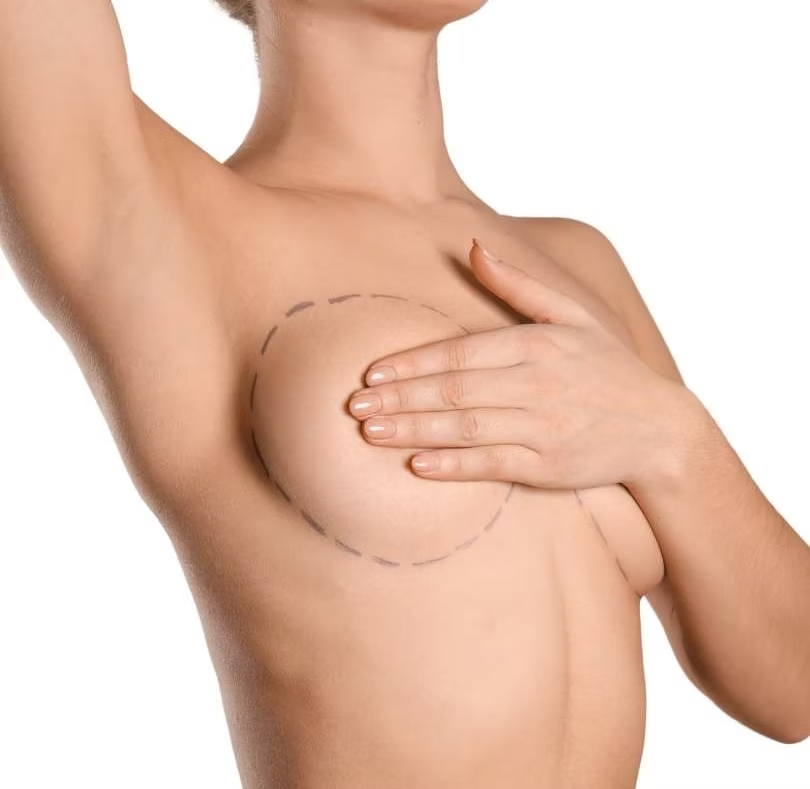 Breast Lift