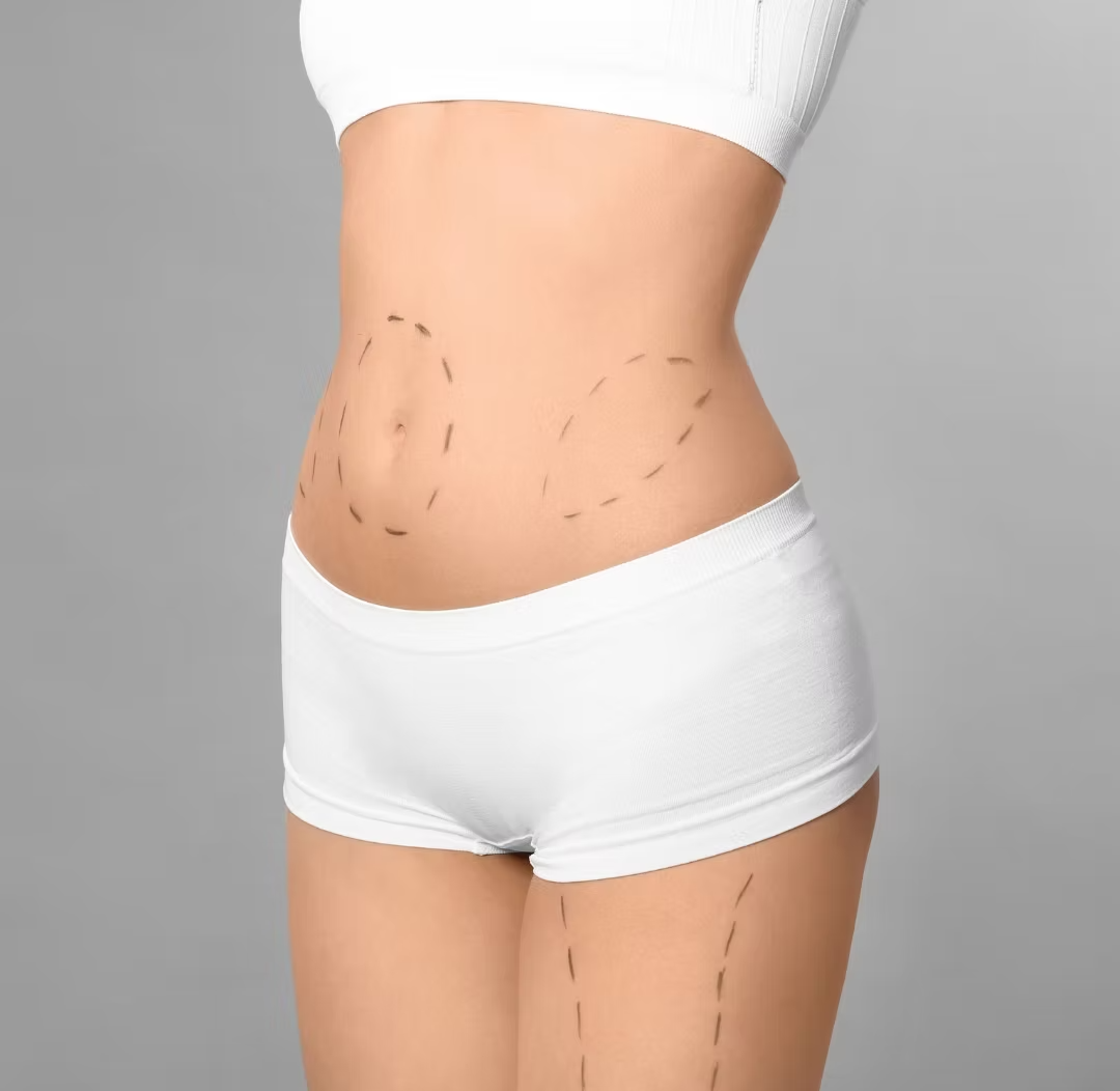 Tummy Tuck